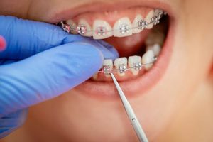 Orthodontic Appliance Care - Hook Orthodontics