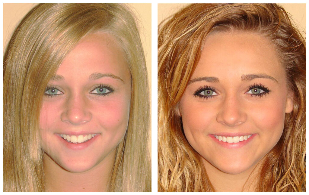 Before & After Invisalign® - Hook Orthodontics