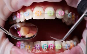 clear braces hook orthodontics
